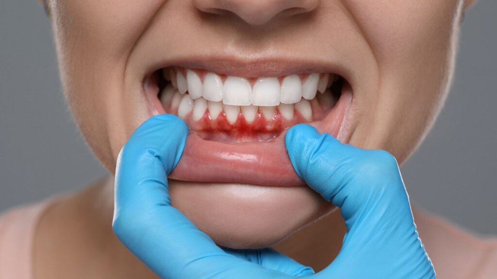 Encías inflamadas con síntomas de gingivitis antes del tratamiento periodontal en Las Palmas