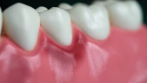 Dibujo encías inflamadas con síntomas de gingivitis antes del tratamiento periodontal en Las Palmas