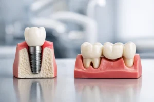 Implantes o puente dental: cuál conviene