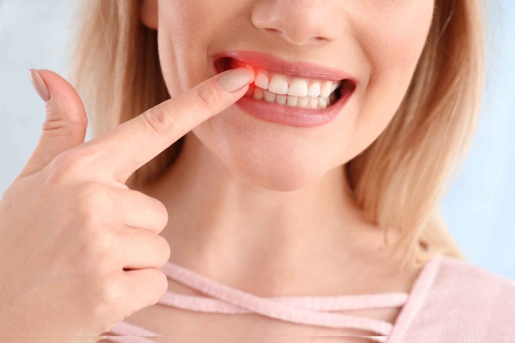 Tratamiento de gingivitis cómo cuidar las encías