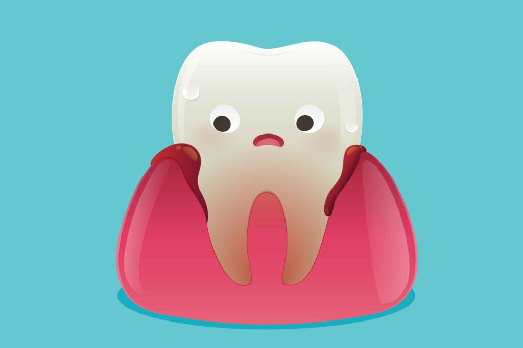 Tratamiento de gingivitis cómo cuidar las encías