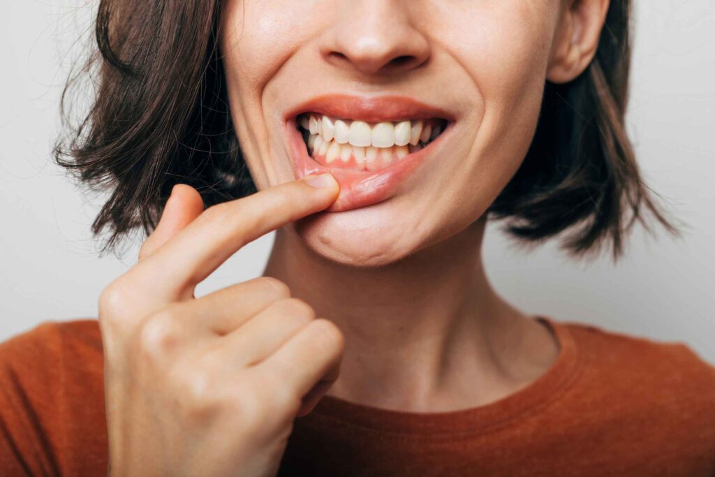 Tratamiento de gingivitis cómo cuidar las encías